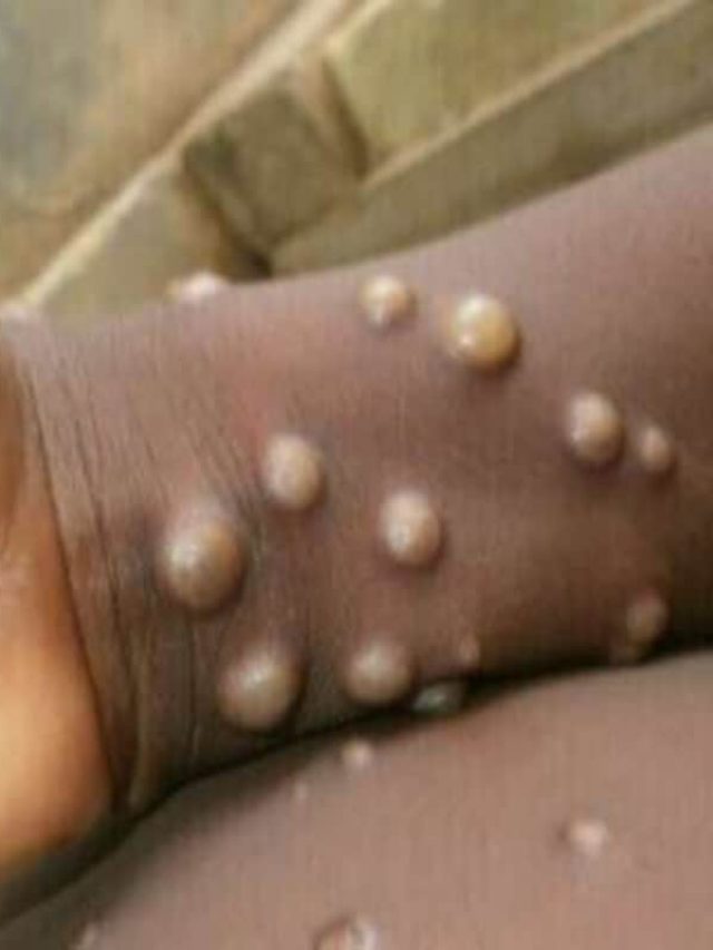 Monkeypox